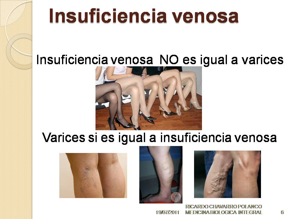 Las medicinas interiores de varikoza